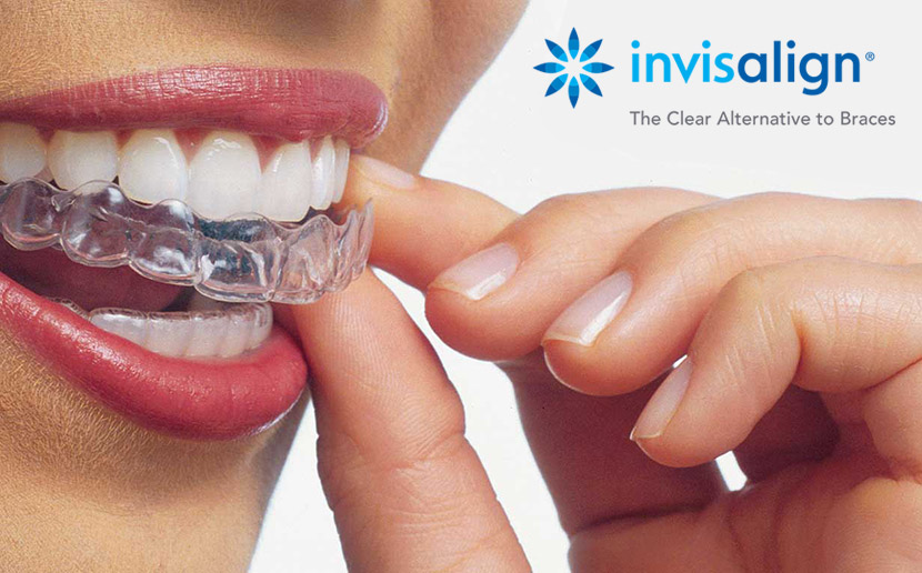 Invisalign - apparecchio mobile invisibile - Ortodonzia invisibile - Piemonte Invisalign - apparecchio mobile invisibile - Ortodonzia invisibile - Piemonte